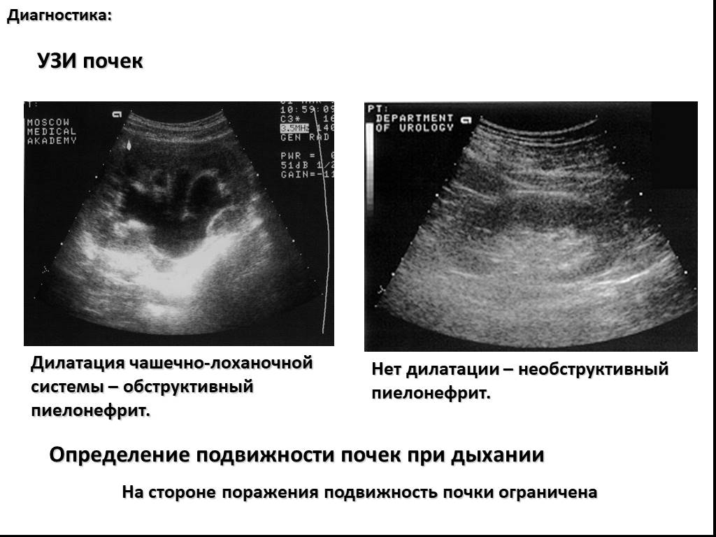 Узи почек где. Хронический пиелонефрит УЗИ. Острый пиелонефрит УЗИ. УЗИ почек при остром пиелонефрите. УЗИ критерии хронического пиелонефрита.