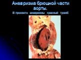 Аневризма брюшной части аорты. В просвете аневризмы красный тромб