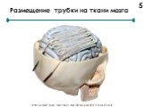 Размещение трубки на ткани мозга. внешний вид пленки на поверхности мозга