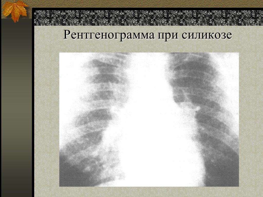 Силикоз. Силикоз 1 стадия рентген. Силикоз рентген признаки. Силикоз легких рентген. Силикоз рентген стадии.