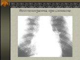 Рентгенограмма при силикозе