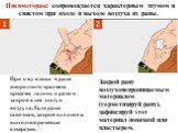 При отсутствии в ране инородного предмета прижми ладонь к ране и закрой в нее доступ воздуха. Если рана сквозная, закрой входное и выходное раневые отверстия. Закрой рану воздухонепроницаемым материалом (герметизируй рану), зафиксируй этот материал повязкой или пластырем. Пневмоторакс сопровождается