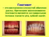 Гингивит. – это воспаление слизистой оболочки десны. Причинами возникновения гингивита являются не правильная гигиена полости рта, зубной налёт.