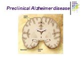 Preclinical Alzheimer disease