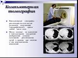 Компьютерная томография. Компьютерные томографы - рентгенодиагностические установки, получающие томографические срезы любой части тела. Метод основан на выявлении и компьютерном построении изображения степени поглощения рентгеновских лучей в органах при наличии в них анатомических изменений.