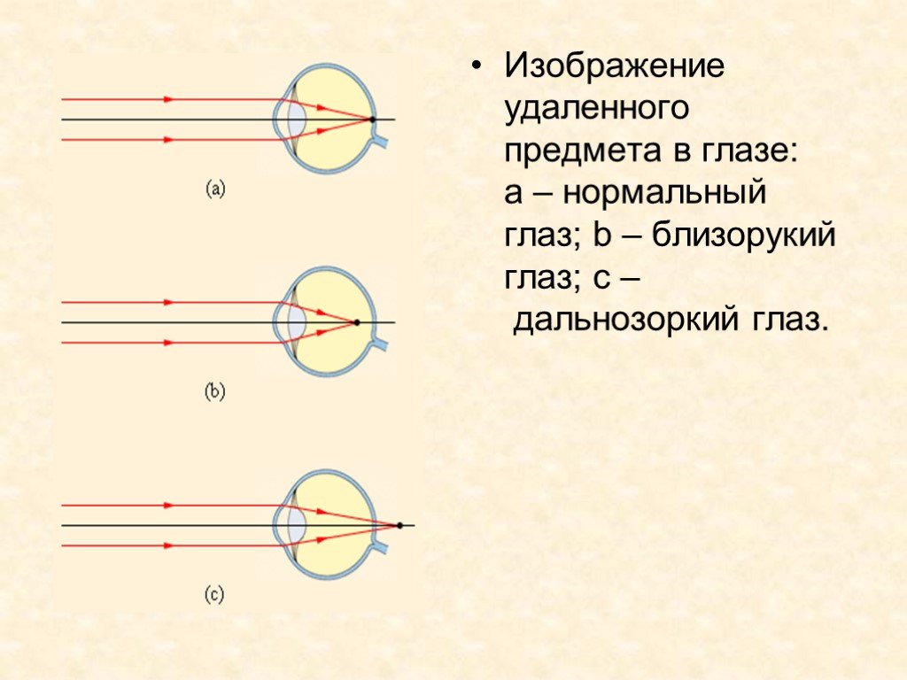 Дополните предложение изображение в близоруком глазу