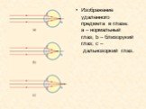 Изображение удаленного предмета в глазе: a – нормальный глаз; b – близорукий глаз; с – дальнозоркий глаз.