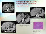 Гиперваскулярный ГЦР, осложненный тромбозом воротной вены. тромбоз воротной вены. атипичные клетки ГЦР, опухолевый эмбол в ветви воротной вены. А-F Р-F