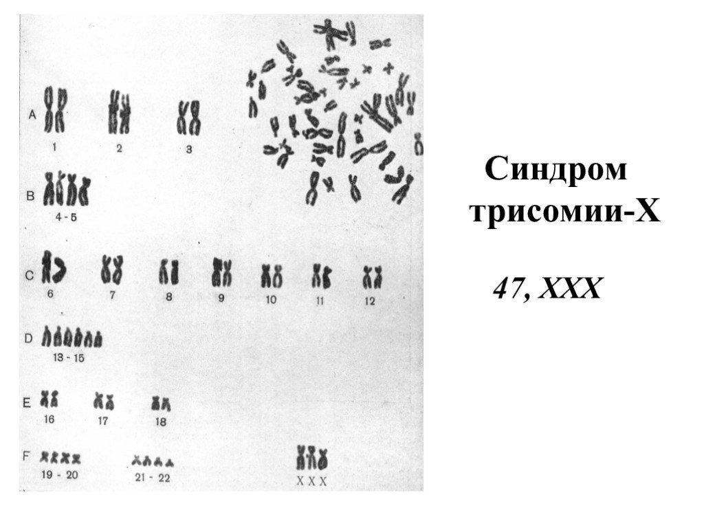 Фото трипло. Синдром трисомии х кариотип. Трисомии по х-хромосоме кариотип. Трисомия х хромосомы кариотип. Синдром трипло-х кариотип.