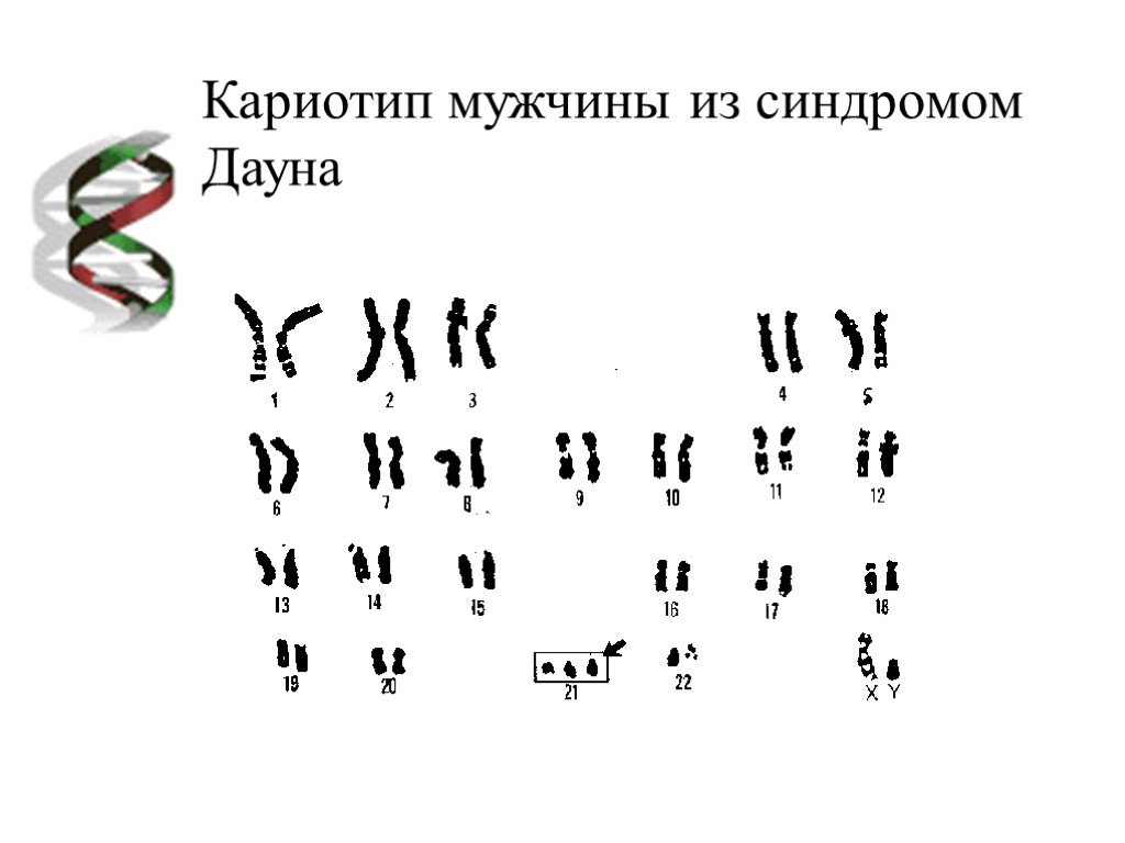 Кариотип синдрома дауна. Кариотип синдрома Дауна формула. Синдром Дауна транслокация кариотип. Кариотип больного с синдромом Дауна. Цитогенетический метод синдром Дауна.