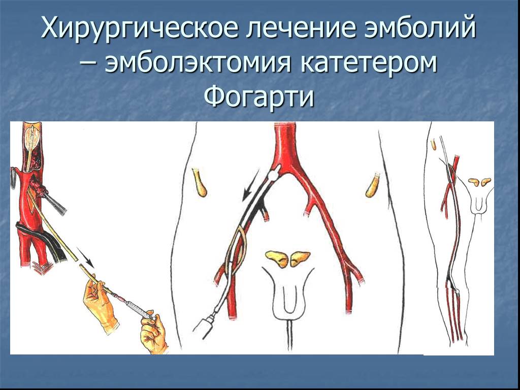 Катетер фогарти. Эмболэктомия катетером Фогарти. Эндоваскулярная катетерная тромбэктомия вен нижних конечностей. Тромбэктомия из артерий нижних конечностей.