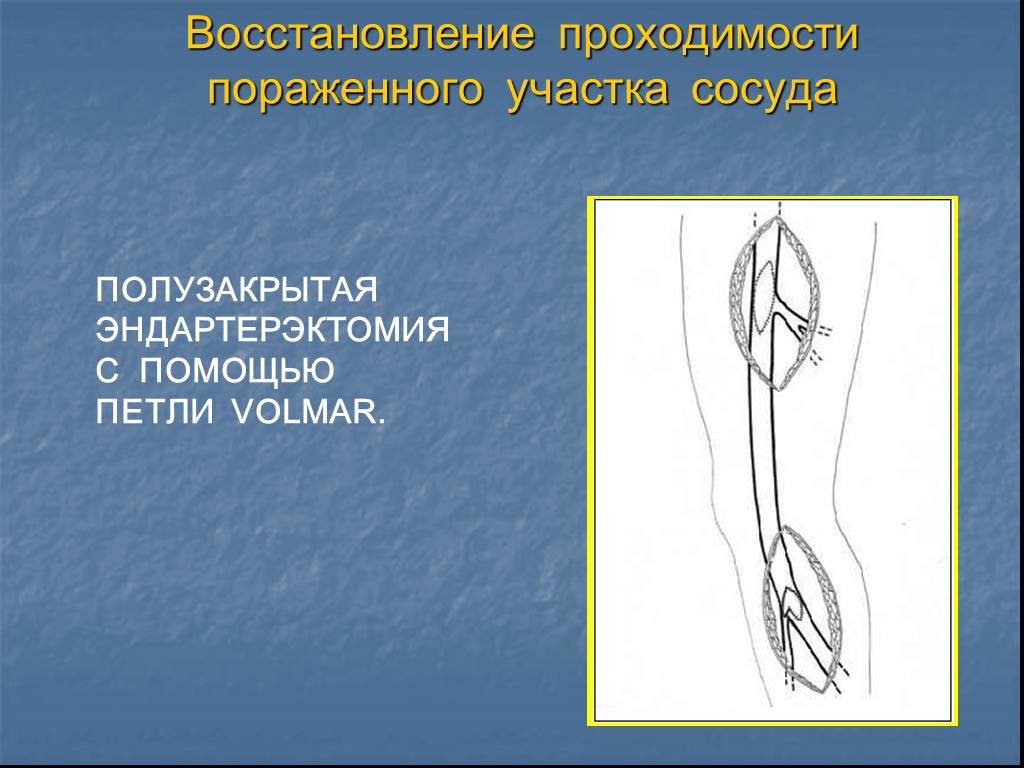 Полу закрыт. Полузакрытая эндартерэктомия. Полузакрытая петлевая эндартерэктомия. Заболевания артерий нижних конечностей презентация. Полуоткрытая эндартерэктомия.