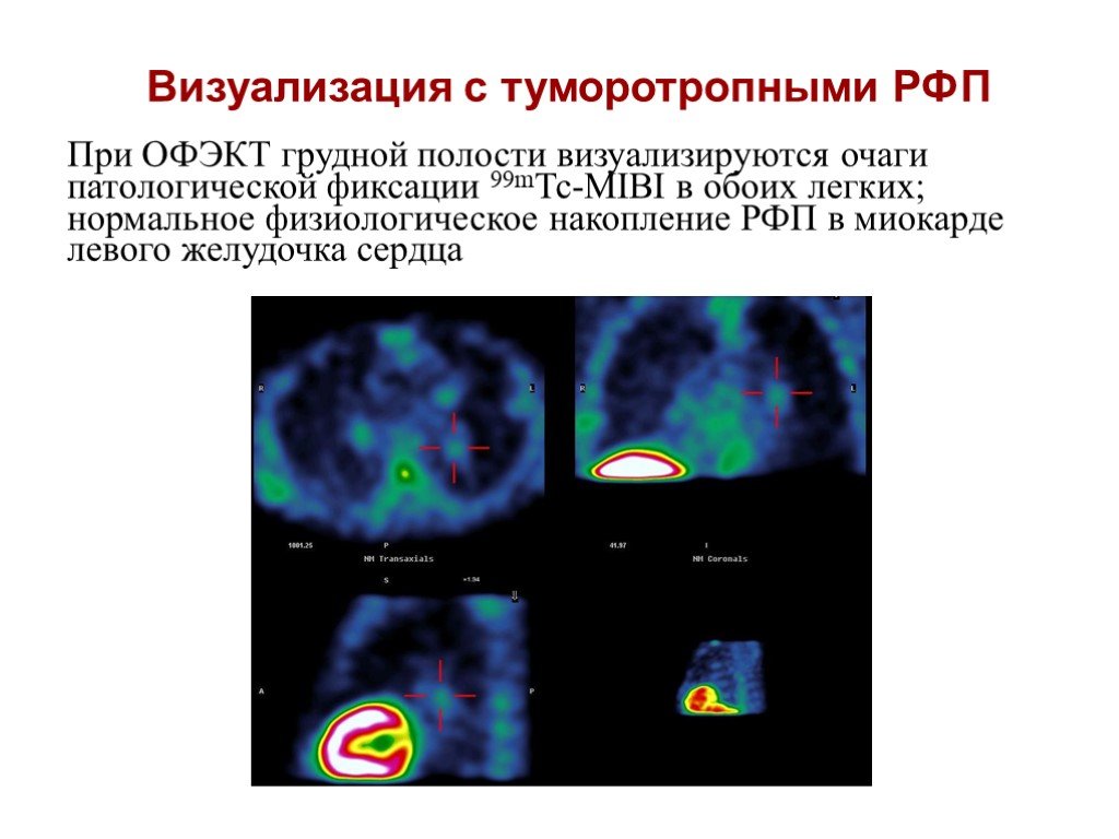 Рфп при пэт кт. Сцинтиграфия ОФЭКТ ПЭТ. ПЭТ/кт с туморотропными РФП (18f-фтордезоксиглюкоза). Сцинтиграфия (радионуклидная диагностика). Туморотропные радиофармпрепараты.