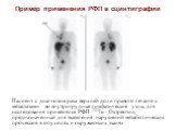 Пример применения РФП в сцинтиграфии. Пациент с диагнозом рака верхней доли правого легкого с метастазами во внутригрудные лимфатические узлы, для исследования применялся РФП 111In - Октреотид, предназначенный для выявления нарушений метаболических процессов в опухолях и окружающих тканях