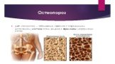 Остеопороз. (лат. osteoporosis) — заболевание, связанное с повреждением (истончением) костной ткани, ведущее к переломами деформации костей.