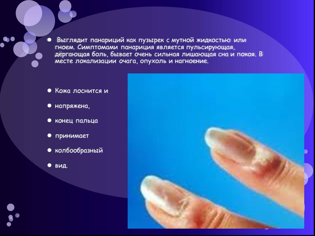 Панариций виды. Классификация панарициев пальцев. Панариций классификация.
