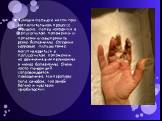 Функция пальца и кисти при воспалительном процессе нарушена: палец находится в полусогнутом положении и попытки его выпрямить резко болезненны. Соседние здоровые пальцы также могут находиться в полусогнутом положении, но движения в них возможны и менее болезненны. Очень часто панариций сопровождаетс