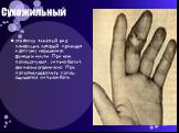 Сухожильный. это более тяжёлый вид панариция, который приводит к долгому нарушению функции кисти. При нём, палец опухает, сильно болит, движение ограничено. При попытках разогнуть палец ощущается сильная боль.