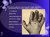 Клиника: в области межпальцевой складки возникает болезненная припухлость, раздвигающая пальцы, и гиперемия, выраженная преимущественно на тыле кисти. Общая реакция бывает выражена в различной степени.