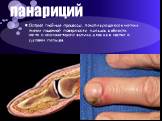 панариций. Острые гнойные процессы, локализующиеся в мягких тканях ладонной поверхности пальцев, в области ногтя и околоногтевого валика, а так же в костях и суставах пальцев.