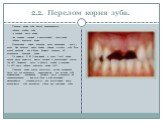 2.2. Перелом корня зуба. Перелом корня зуба может локализоваться: - вблизи шейки зуба, - в средней части корня, - на границе средней и верхушечной трети корня, - вблизи верхушки корня. Направление линии перелома чаще поперечное, реже - косое. Она проходит через цемент, дентин и пульпу зуба. Если щел