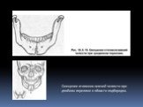 Смещение отломков нижней челюсти при двойном переломе в области подбородка.