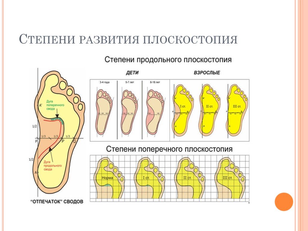 Определение плоскостопия по рисунку