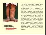 Элефантиазис - cлоновая болезнь. http://www.medkurs.ru/photo/&page=10. У человека некоторые паразиты не только снижают жизнедеятельность, но и могут приводить к инвалидности. В странах с тропическим и субтропическим климатом широко распространены круглые черви нитчатки, получившие название от ни