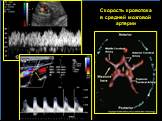 Скорость кровотока в средней мозговой артерии