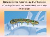 Остиосинтез пластиной LCP Сlavicle при переломах акромиального конца ключицы