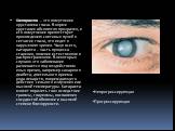 Катаракта – это помутнение хрусталика глаза. В норме хрусталик абсолютно прозрачен, и его помутнение препятствует прохождению световых лучей к сетчатке глаза, что ведет к нарушению зрения. Чаще всего, катаракта – часть процесса старения, явление естественное и распространенное. В некоторых случаях э