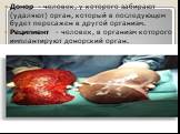 Донор - человек, у которого забирают (удаляют) орган, который в последующем будет пересажен в другой организм. Реципиент - человек, в организм которого имплантируют донорский орган.