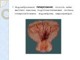 Эндометриальная гиперплазия: полость матки выстлана пышным, подобным пальмовым листьям, гиперпластическим эндометрием; макропрепарат