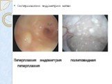 Гистероскопия эндометрия матки Гиперплазия эндометрия полиповидная гиперплазия