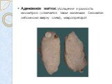 Аденомиоз матки: утолщение и рыхлость миометрия (отмечается также маленькая беловатая лейомиома вверху слева); макропрепарат