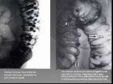 Стадия полных дивертикулов. Множественные дивертикулы нисходящей кишки. Сочетание интрамурального (вертикальная стрелка) и полных дивертикулов в виде кольцевидной тени (горизонтальная стрелки) и дополнительной тени (фигурная стрелка).