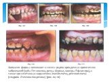 Аномалии формы возникают в связи с рядом врожденных хронических заболеваний (зубы Гетчинсона, резцы Фурнье, моляры Пфлюгера), а также при сочетанных нарушениях амелогенеза, дентиногенеза (синдром Стентона-Капдепона) (рис. 107-111)