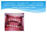 3) микродонтия (микродентизм) – малые размеры коронки зуба по сравнению со средним размером коронок той же группы зубов