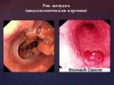 Рак желудка (эндоскопическая картина)