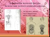 Деформация женской фигуры вследствие долгого ношения корсета. Так рисовали женские тела в медицинских книгах 1911 года