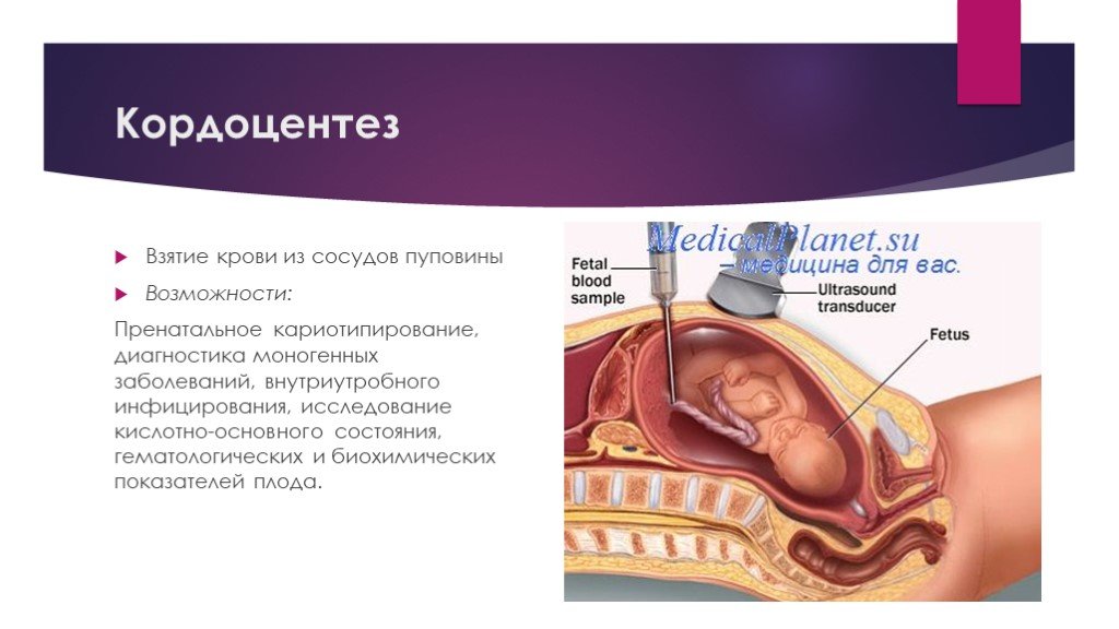Инвазивный тест при беременности. Инвазивные методы пренатальной диагностики плода кордоцентез. Биопсия хориона амниоцентез кордоцентез. Трансабдоминальный кордоцентез. Кордоцентез сущность метода.