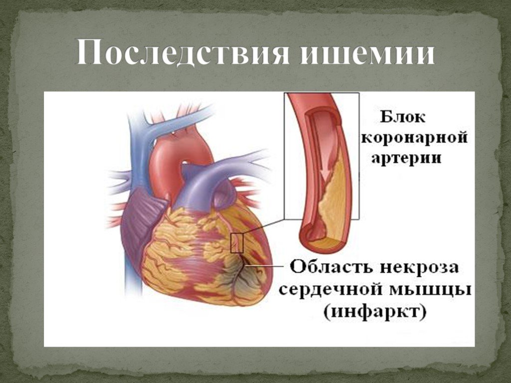 Инфаркт миокарда последствия