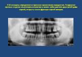 У 44 женщины определяются признаки хронического пародонтита. Разрушение краевых отделов альвеолярных отростков у многих зубов достигло двух третей длины корней, открыты места фуркации корней моляров.