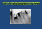 Пародонтопатии вследствие травмы. Избыток пломбировочного материала в области фуркации корней 36 зуба. Повреждение периодонта и мезиального корня, вызванное подготовкой канала к пломбировке, вследствие этого костная ткань между корнями разрушена. Рецидив глубокого кариеса мезиально на 37 зуба.