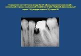 Разрушение костной ткани между 35 и 37 зубами, вызванное нависающей с мезиальной стороны амальгамной пломбой на 37 зубе. Глубокий апроксимальный кариес 34, рецидив кариеса 37, кариес 38.