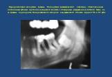 Пародонтопатия вследствие травмы. Последствия травматической окклюзии, обусловленные постоянным зубным протезом на верхней челюсти с обширным разрушением костной ткани из-за травмы периодонта. Зона реактивного склероза в верхушечной области корней 36 и 37 зуба