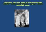 Радикулярную кисту такого размера на 22 зубе рентгенологически невозможно отличить от инкапсулированной гранулемы. Состояние после некроза пульпы.