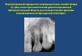 Периапикальный пародонтит на внутриротовом снимке. Вокруг 22 зуба, несмотря на клинически диагностированный субпериостальный абсцесс, рентгенологические признаки периапикальных повреждений отсутствуют.