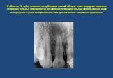 В области 22 зуба, клинически: субпериостальный абсцесс после рецидива кариеса с некрозом пульпы, определяется расширение периодонтальной щели особенно в зоне ее верхушки и участок периапикального просветления с нечеткими границами.