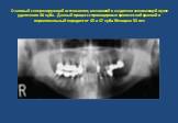 Очаговый склерозирующий остеомиелит, возникший в медленно заживающей лунке удаленного 46 зуба. Данный процесс спровоцировал хронический краевой и периапикальный пародонтит 45 и 47 зуба. Женщина 50 лет.